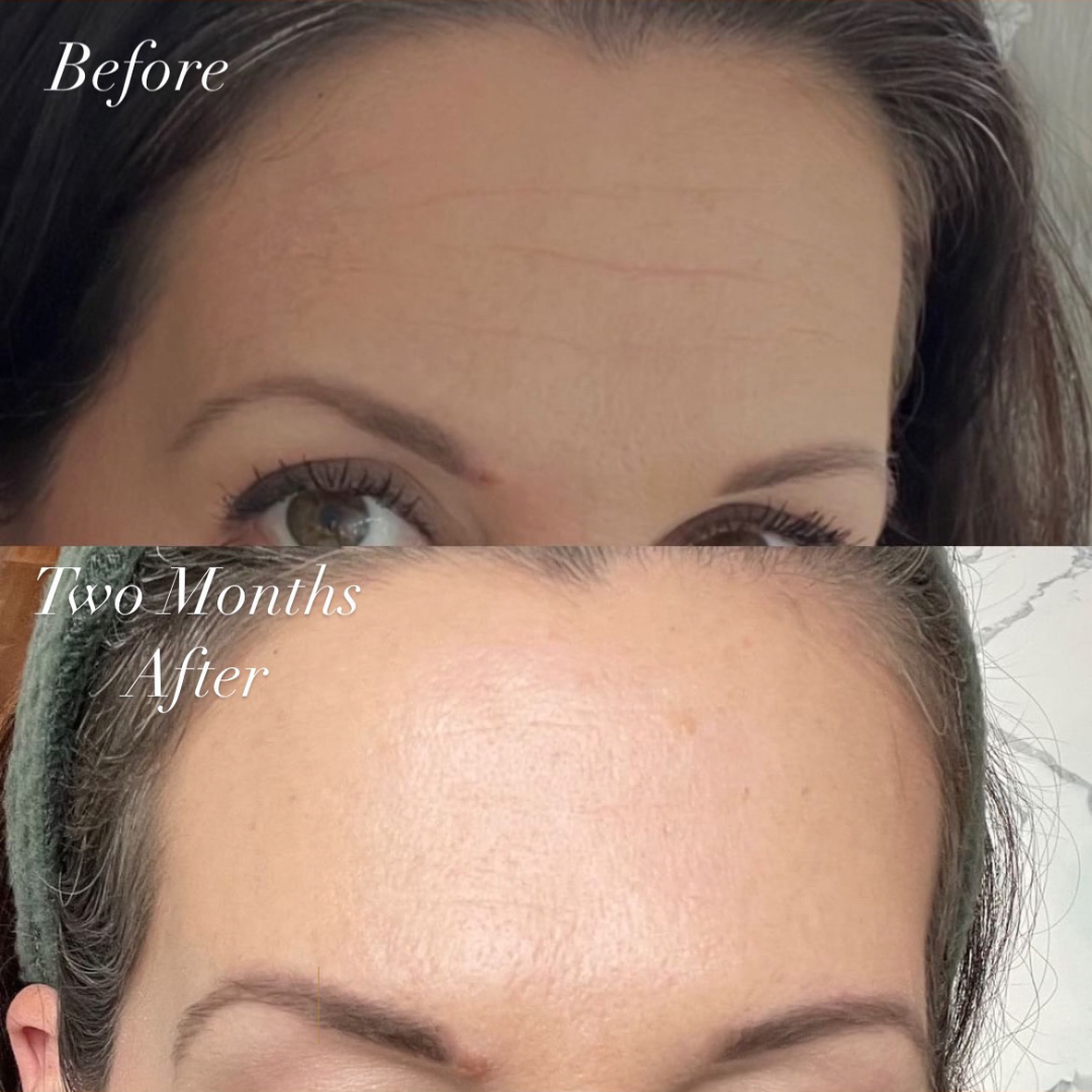 Better Than Botox Bee Venom Vanish Roller