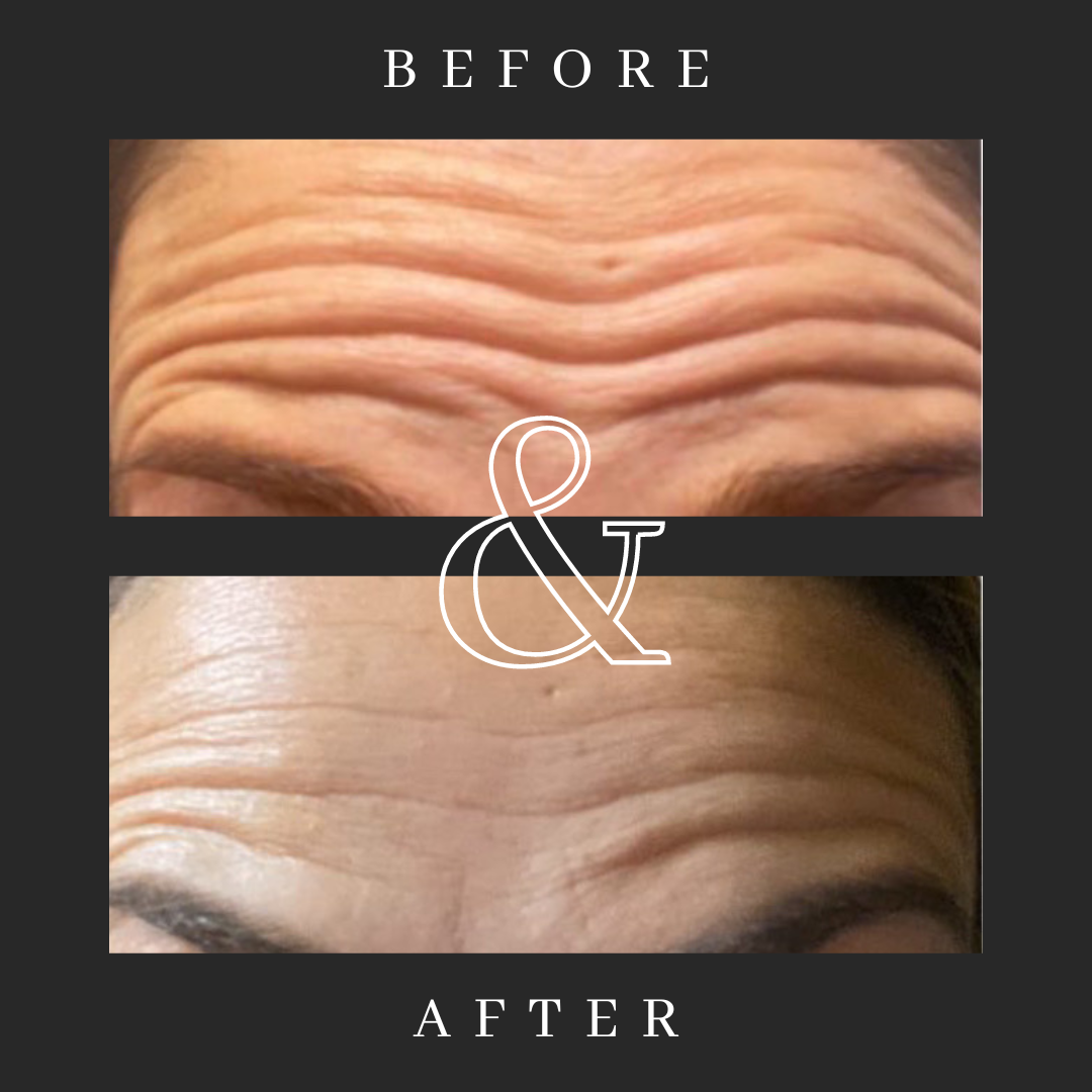 Better Than Botox Bee Venom Vanish Roller