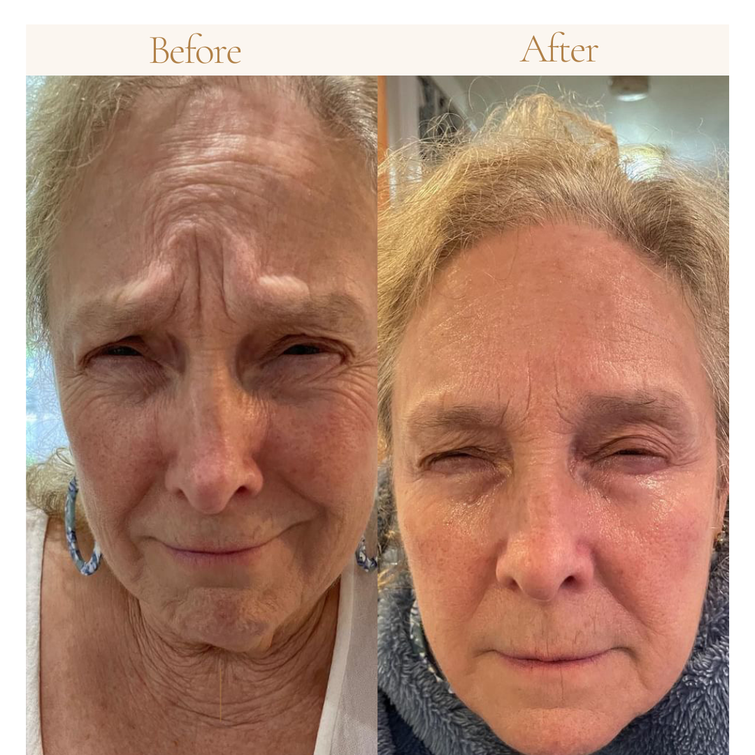 Better Than Botox Bee Venom Vanish Roller